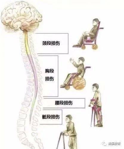 脊髓損傷最新進展,脊髓損傷最新進展